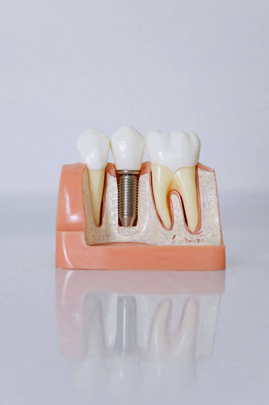 Beispielhafte Darstellung eines Implantats